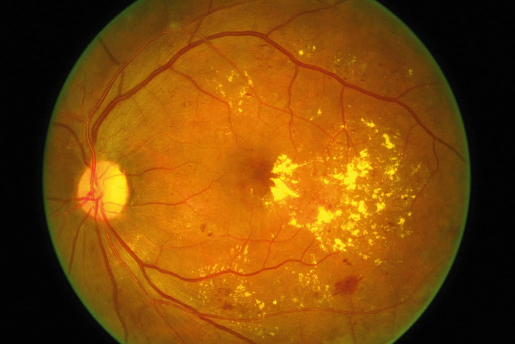 Diabetic Retinopathy Treatment In Mumbai Dr Nishant Kumar 