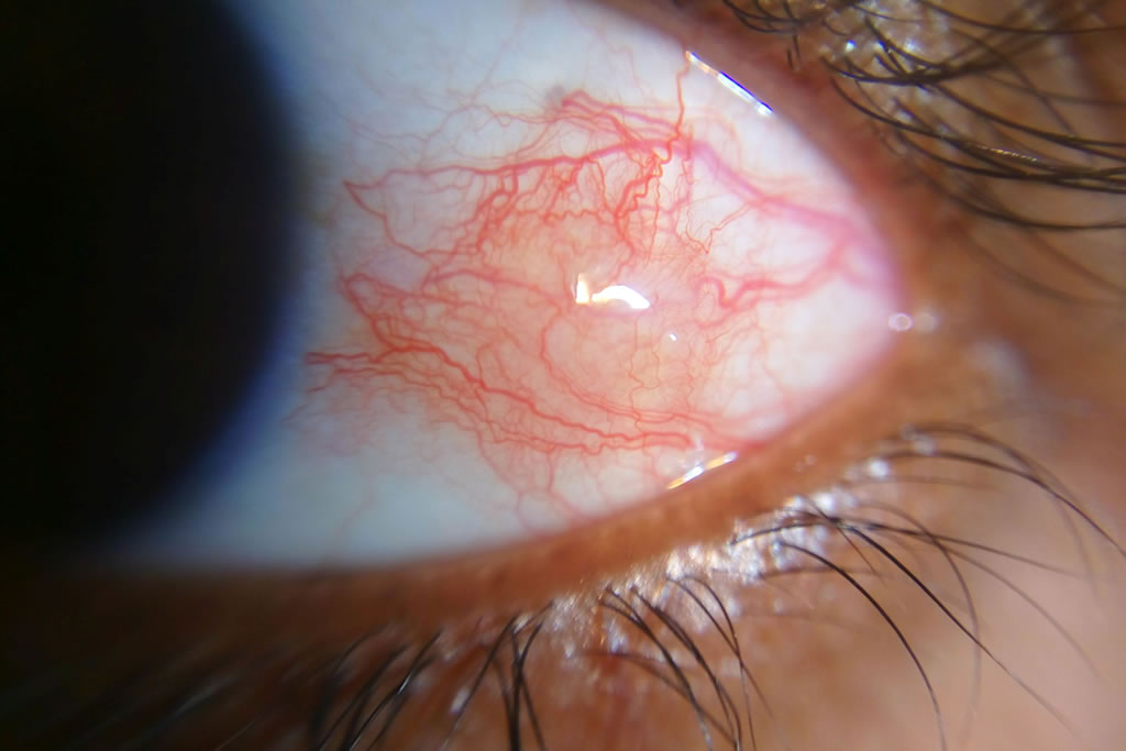 Uveitis – Inflammation and Infectious diseases of the eye